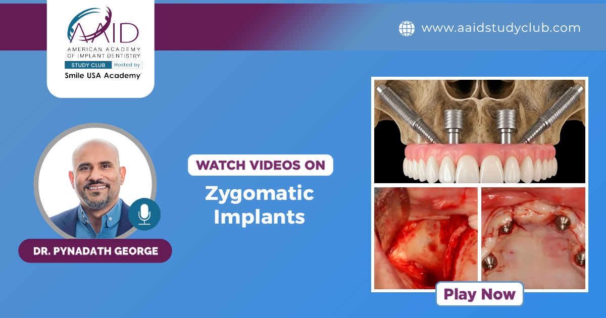 Zygomatic Implants