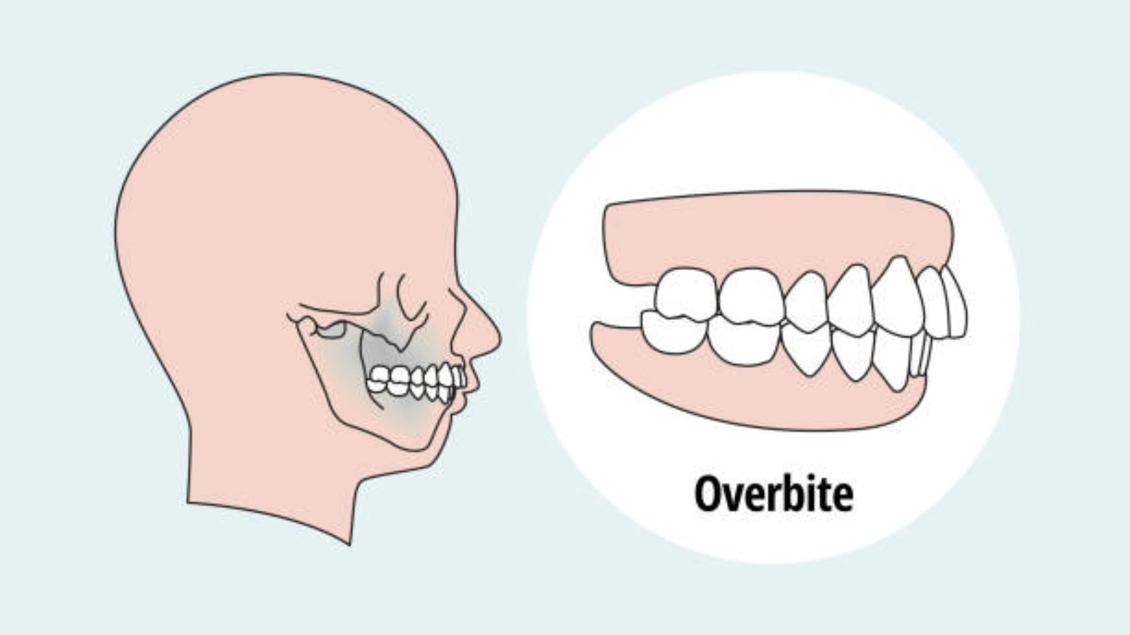 overbite