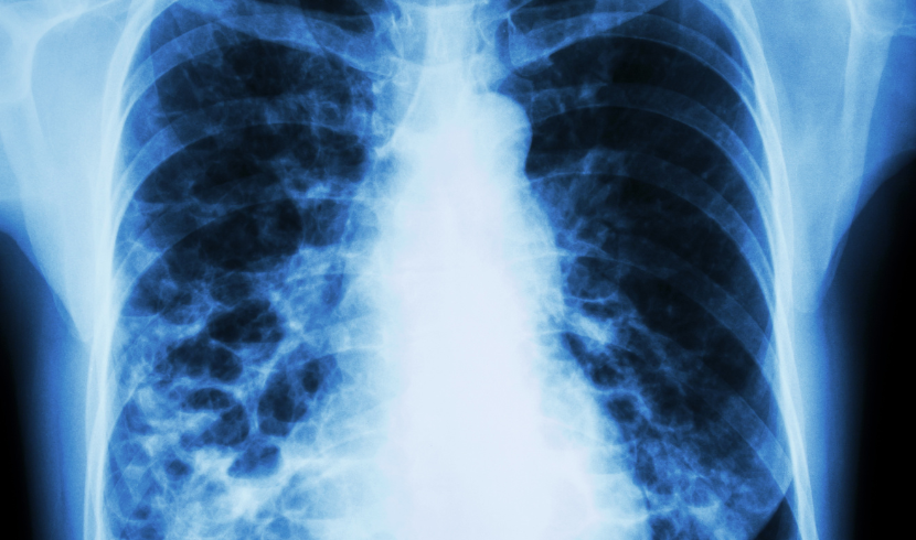 Bronchiectasis-Epidemiology-Forecast.png