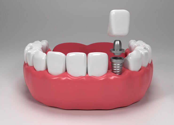 dental-implants.jpg