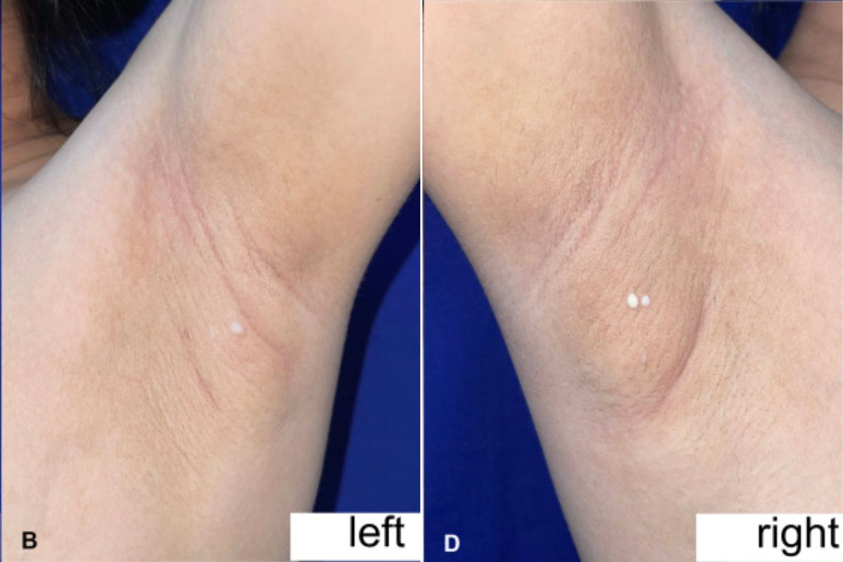 अद्वितीय! नवजात मां की दोनों बगलों से निकलने लगा दूध, दुर्लभ मामले में सामने आई अनोखी जानकारी महिला की बगल