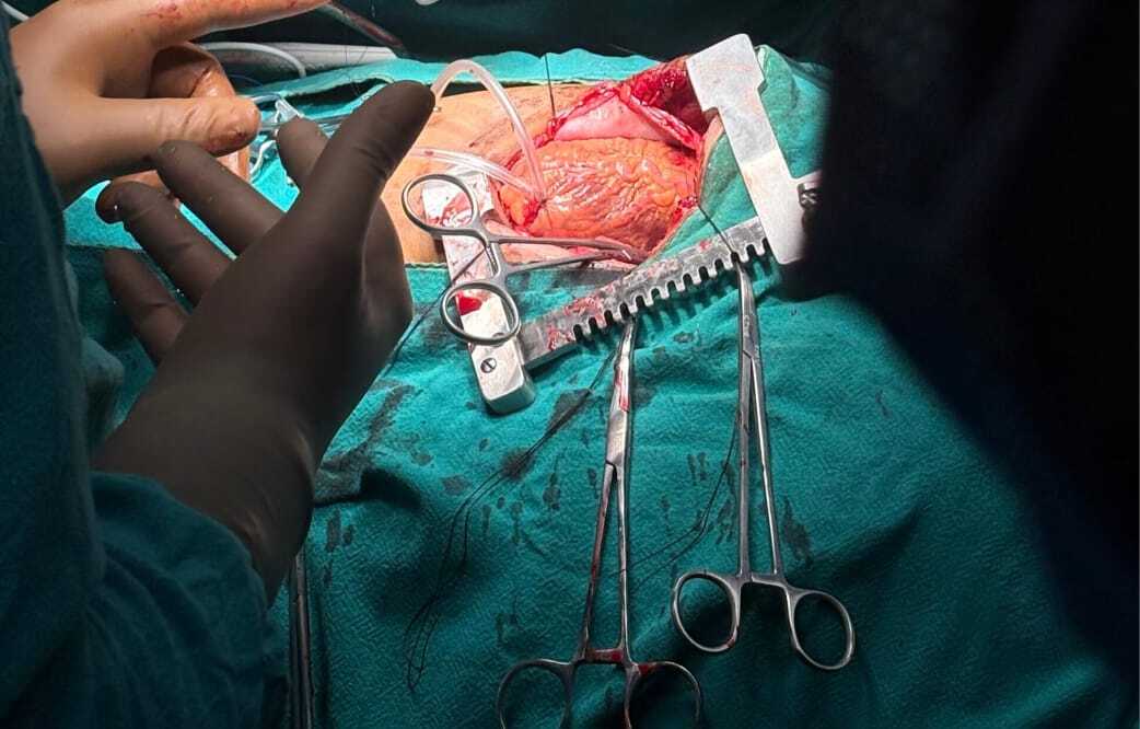 देवघर एम्स में शुरू हुई हार्ट सर्जरी, दो मरीजों का ऑपरेशन सफल