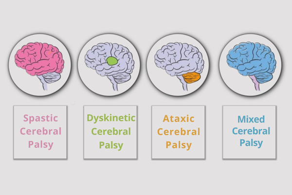 Get best treatment for different types of cerebral palsy disorder in Mumbai at Bombay Hospital
