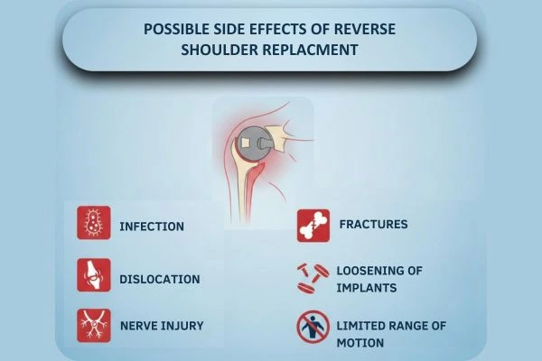 Know some Potential Risks of Reverse Shoulder Replacement Surgery which can be avoided by Dr. Chintan Desai.