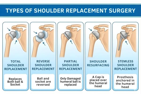 Types of Shoulder Replacement Surgery by Shoulder specialist dr chintan desai in Mumbai.