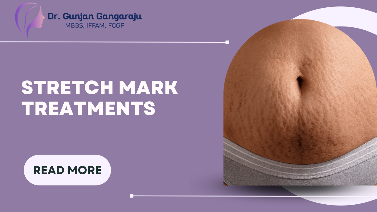 Stretch Mark Treatments That Actually Work: Your Guide to Smooth Skin