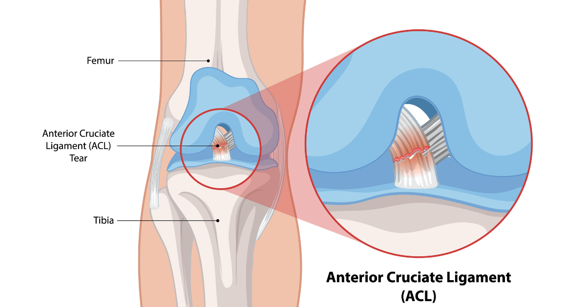ACL Reconstruction in Navi Mumbai