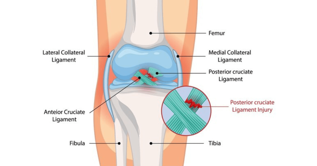Medial Collateral Ligament Injury Treatment
