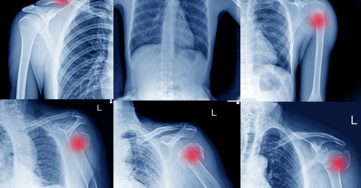 Shoulder Dislocation Treatment