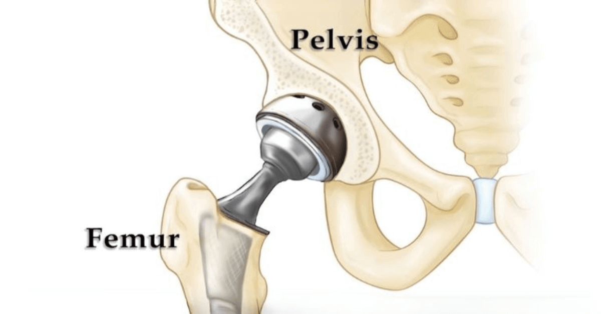 Total Hip Replacement Surgeon in Navi Mumbai