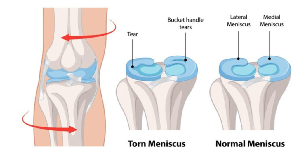 Meniscus Tear Treatment in Navi Mumbai