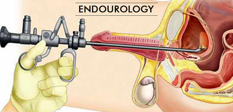 EndoUrological Procedures