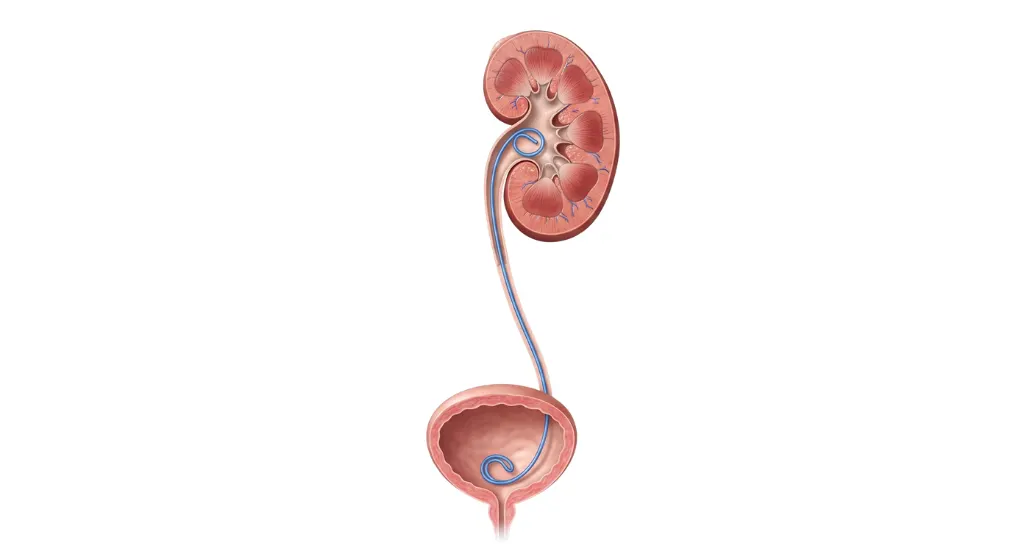 Illustration of Double-J ureteric stent placement