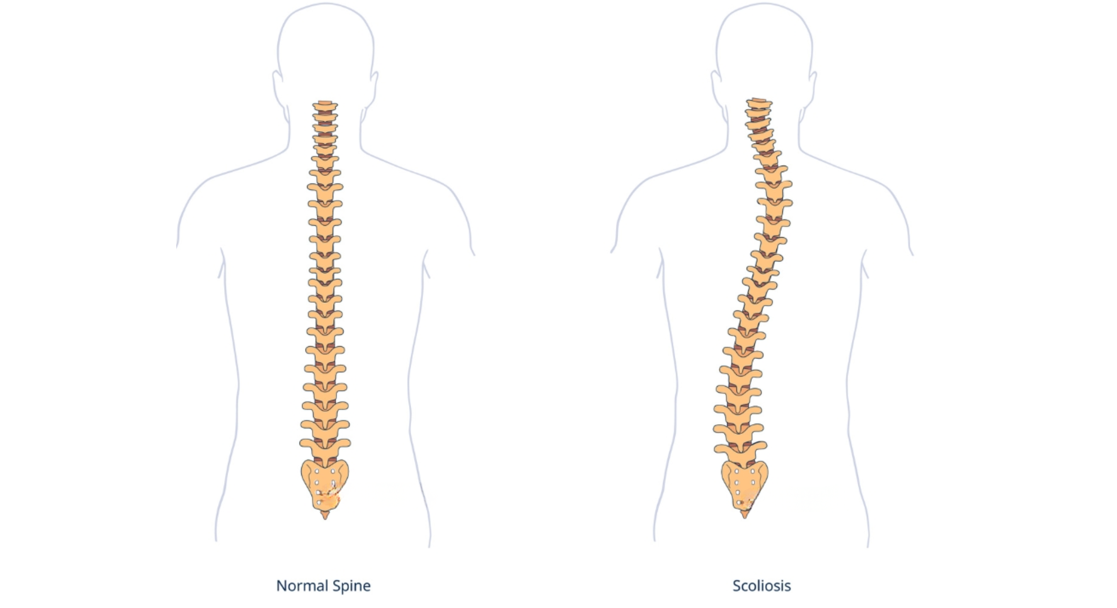 Best Spine Surgeon in Mumbai