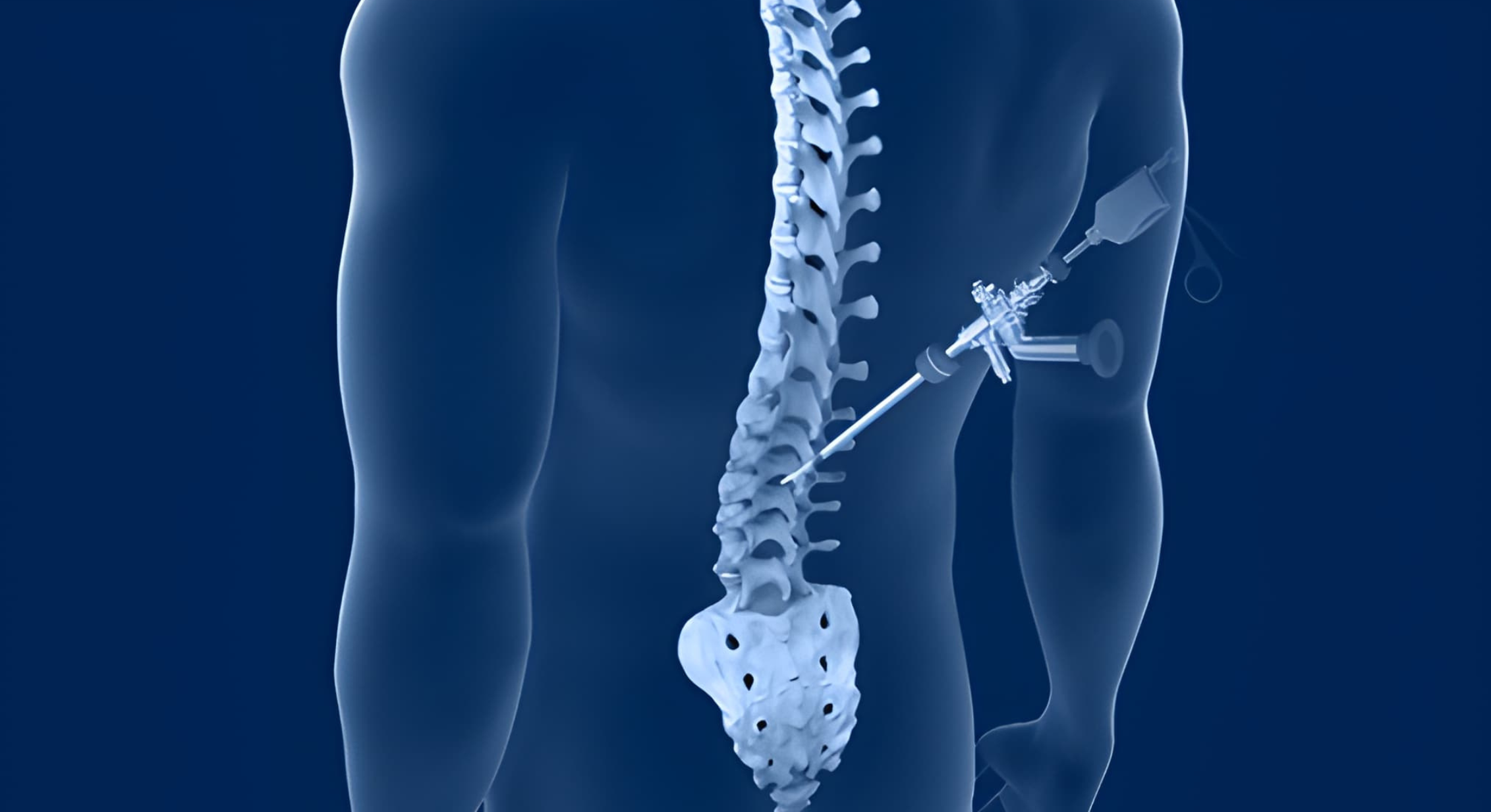 Minimally Invasive Spine Surgery – FAQ