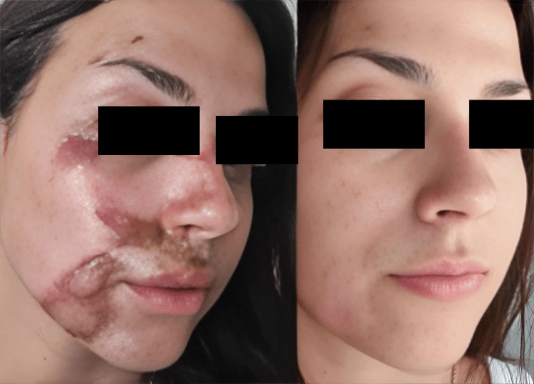 Advanced Burn Reconstruction by Dr. Vinay Jacob in Mumbai