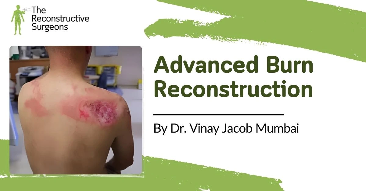 Advanced Burn Reconstruction by Dr. Vinay Jacob in Mumbai