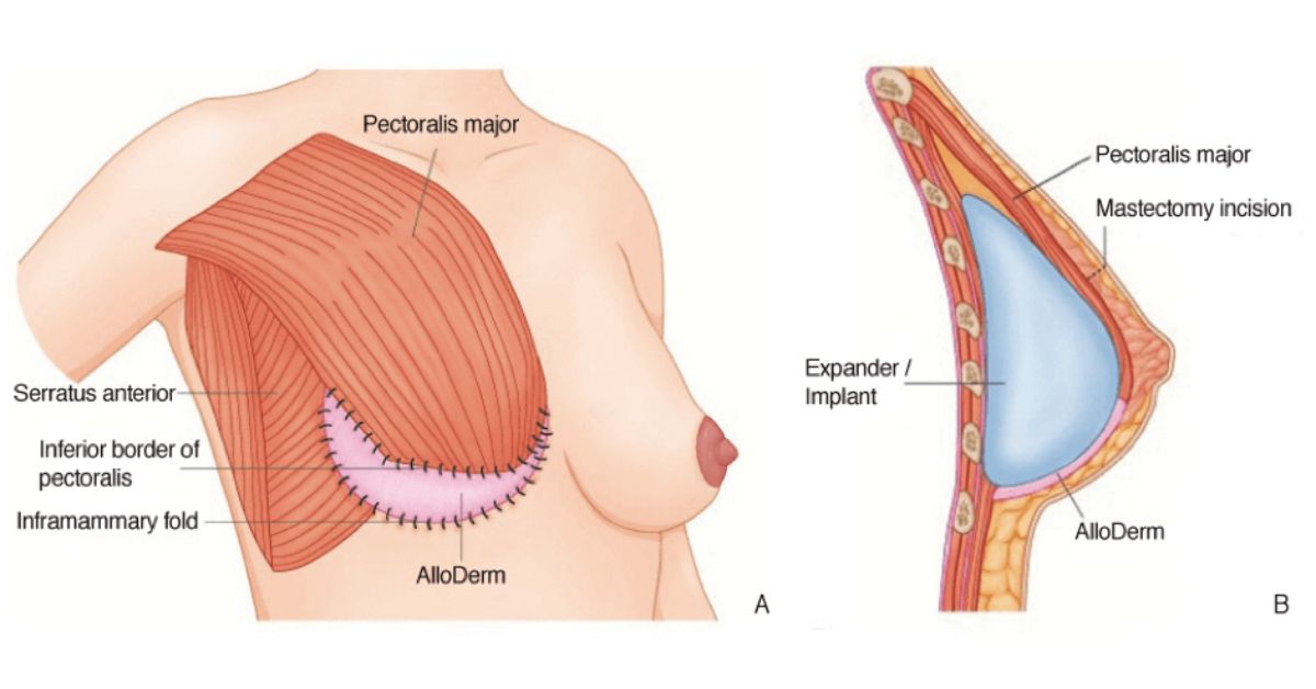 Advanced Implant-Based Breast Reconstruction