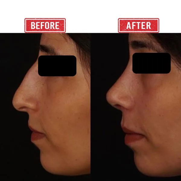Secondary rhinoplasty in Mumbai by Dr. Vinay Jacob