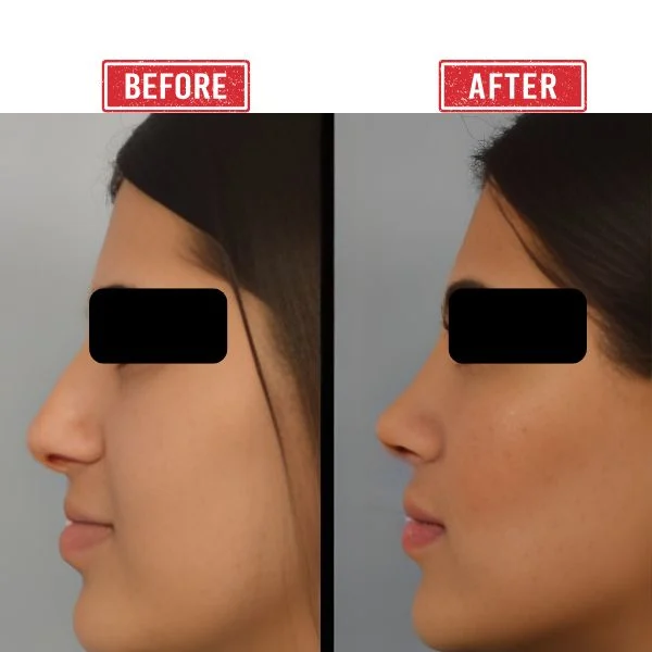 Secondary rhinoplasty Before after result in Mumbai By Dr. Vinay Jacob