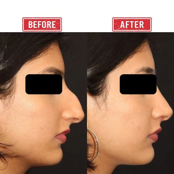 Before after Secondary rhinoplasty result by Dr. Vinay Jacob