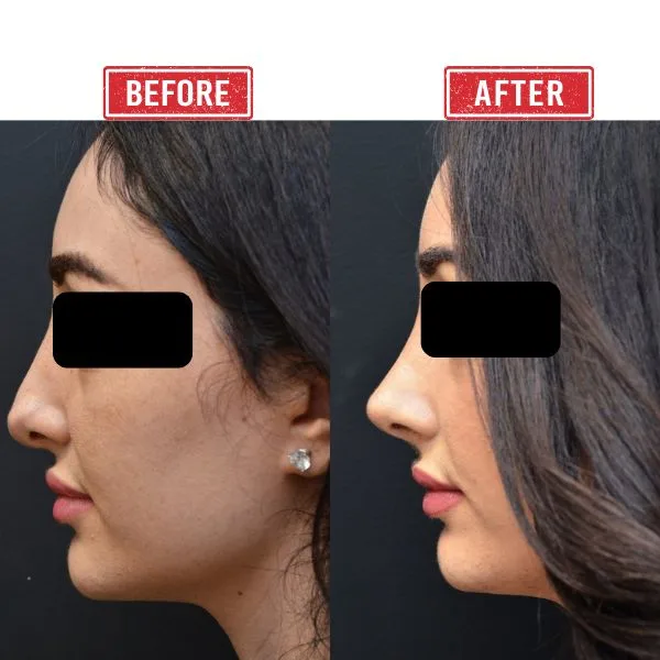 Before after Secondary rhinoplasty Result In Mumbai By Dr Vinay Jacob