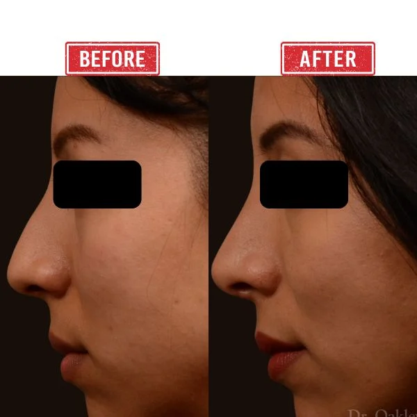 Secondary Rhinoplasty Before after Result