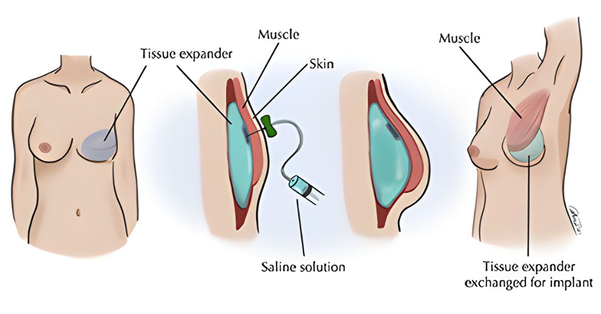 Benefits of Breast Reconstruction