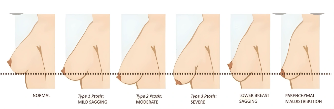 The Evolution of Breast Reduction Surgery
