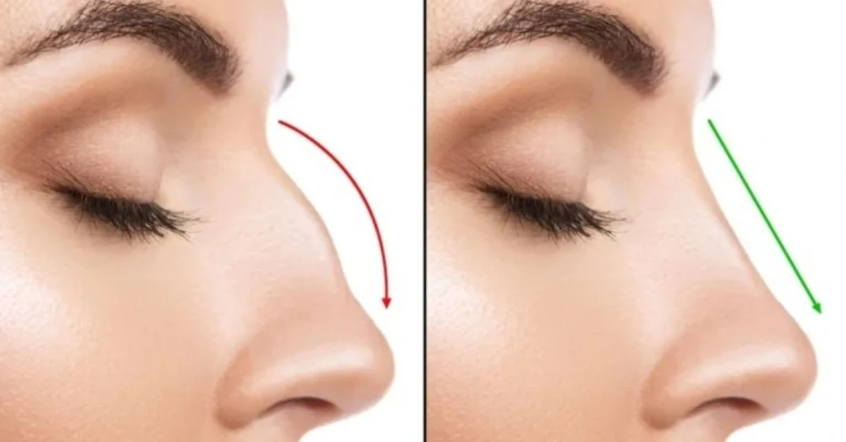 Ideal Candidate for Secondary Rhinoplasty