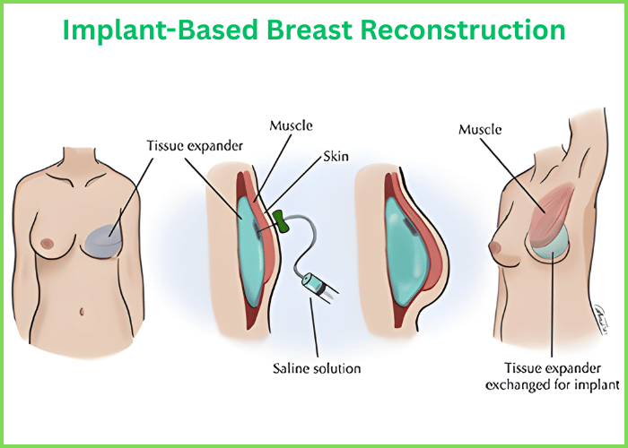 Benefits of Implant-Based Reconstruction