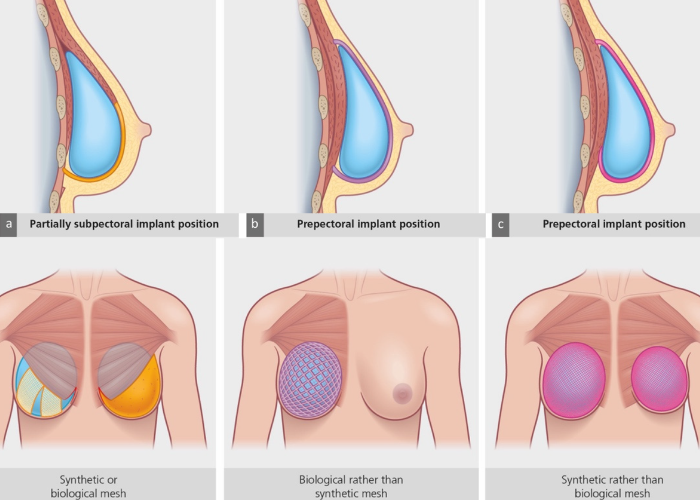 Implant-Based Breast Reconstruction in Mumbai