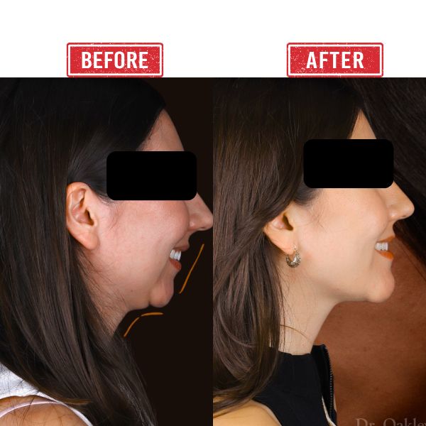 Jaw reconstruction in Mumbai by Dr. Vinay Jacob