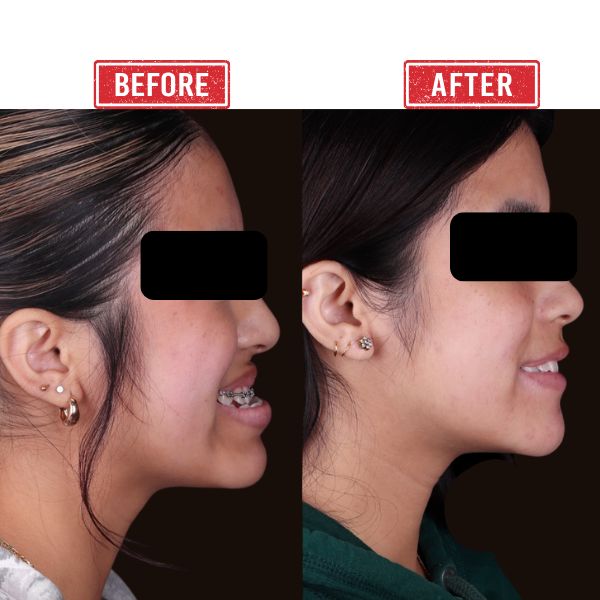 Jaw Reconstruction Before after Result