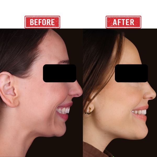 Jaw reconstruction Before after result in Mumbai By Dr. Vinay Jacob