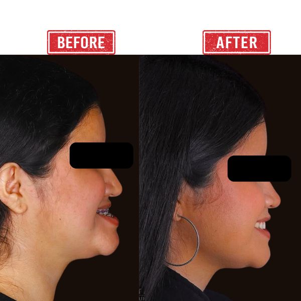 Before after Jaw reconstruction result by Dr. Vinay Jacob
