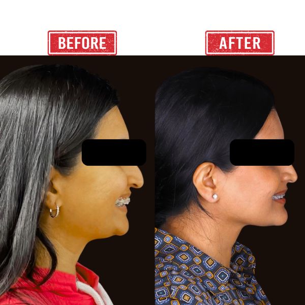 Before after Jaw reconstruction Result In Mumbai By Dr Vinay Jacob