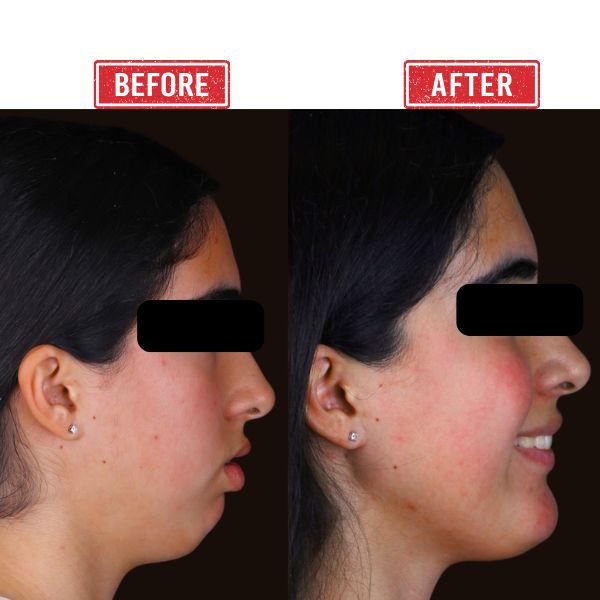 Jaw Reconstruction Before after Result