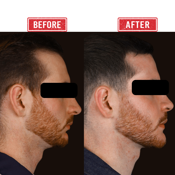 Jaw Reconstruction Before after Result