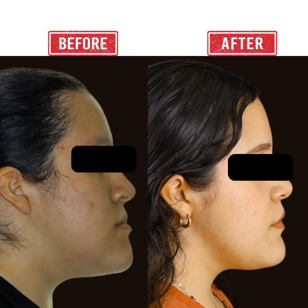 Jaw Reconstruction Before after Result