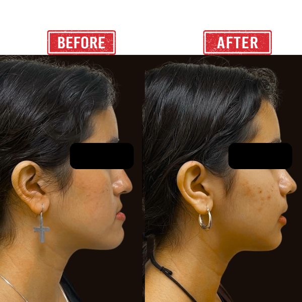 Jaw Reconstruction Before after Result