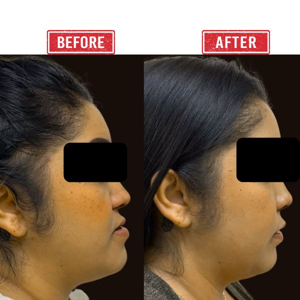 Jaw Reconstruction Before after Result