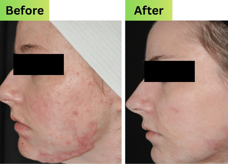 recovery of burn reconstruction in mumbai