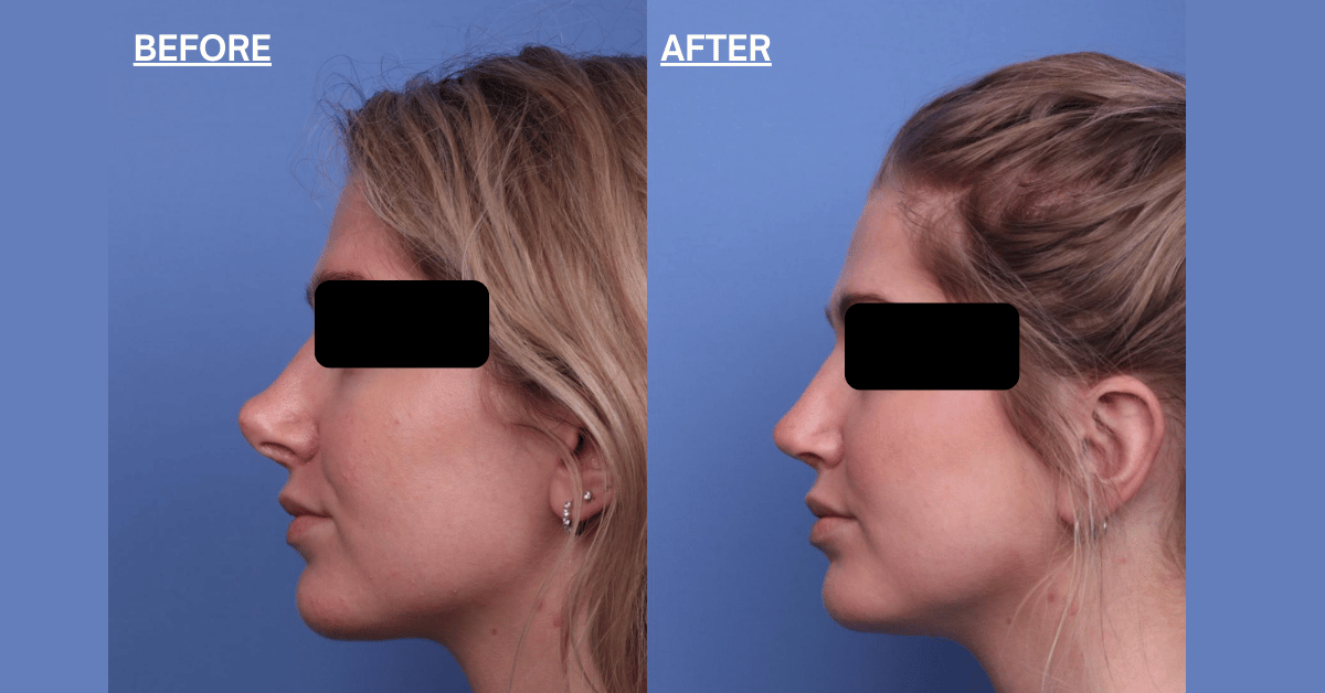 Secondary Rhinoplasty