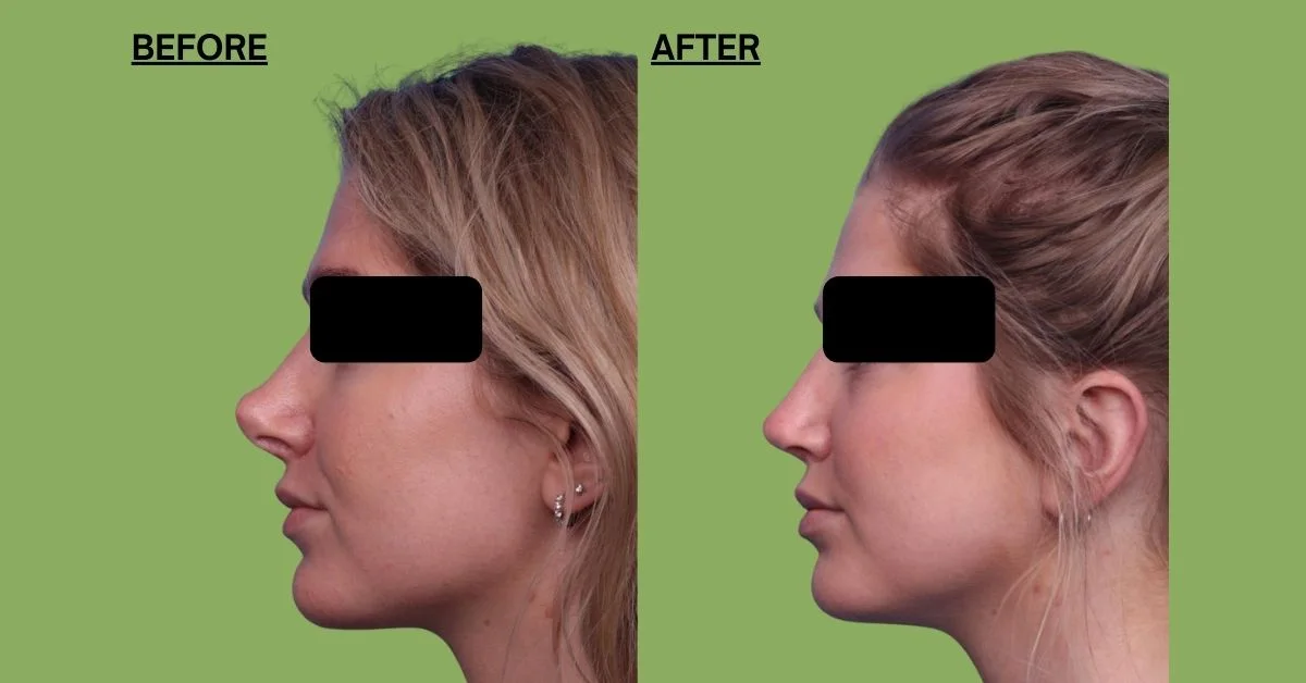 Secondary Rhinoplasty Surgery in Mumbai