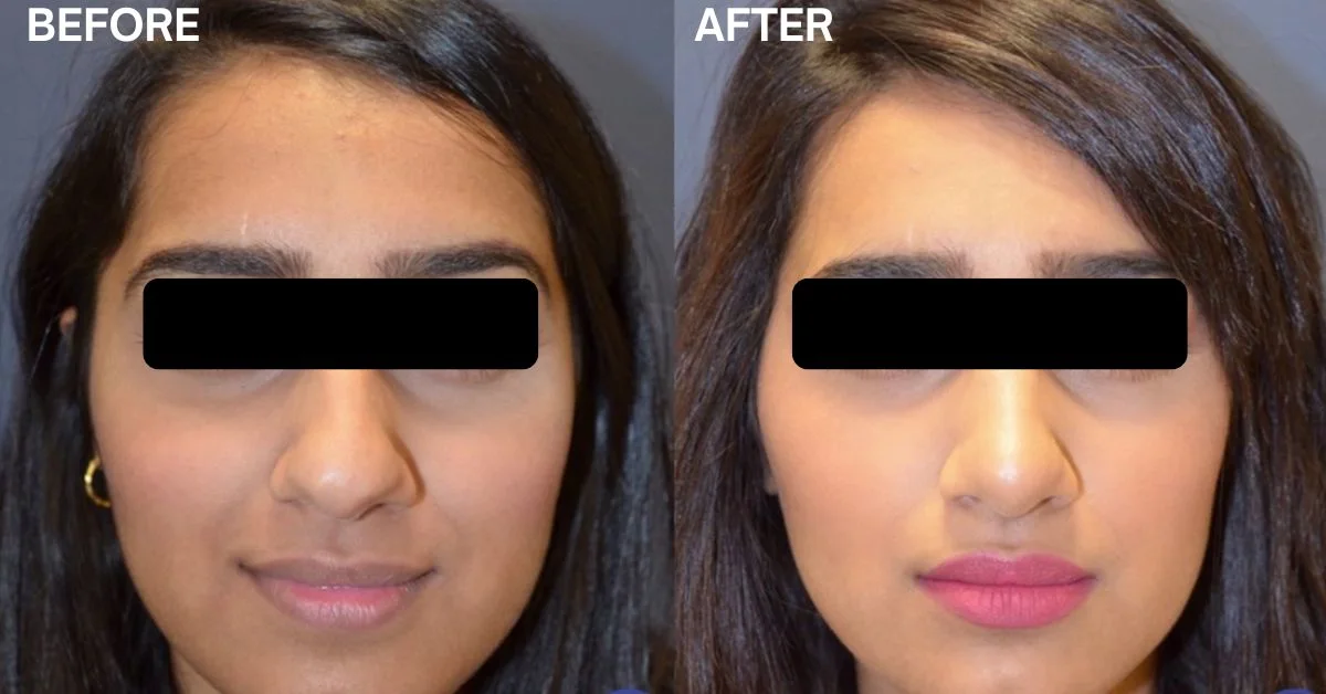 Factors Influencing Nose Plastic Surgery Cost in Mumbai