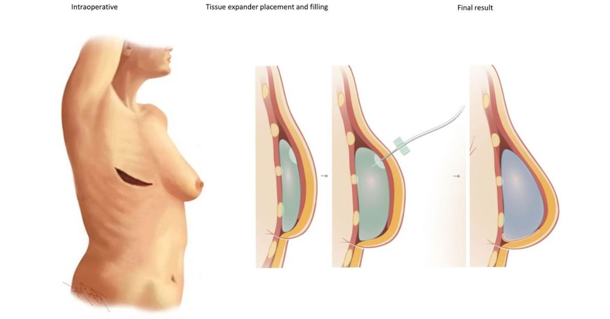 How to get Natural-Looking Results by Breast Implants