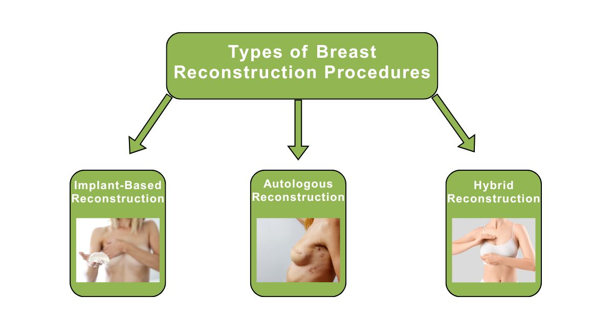 Types of Breast Implants Used in Reconstruction