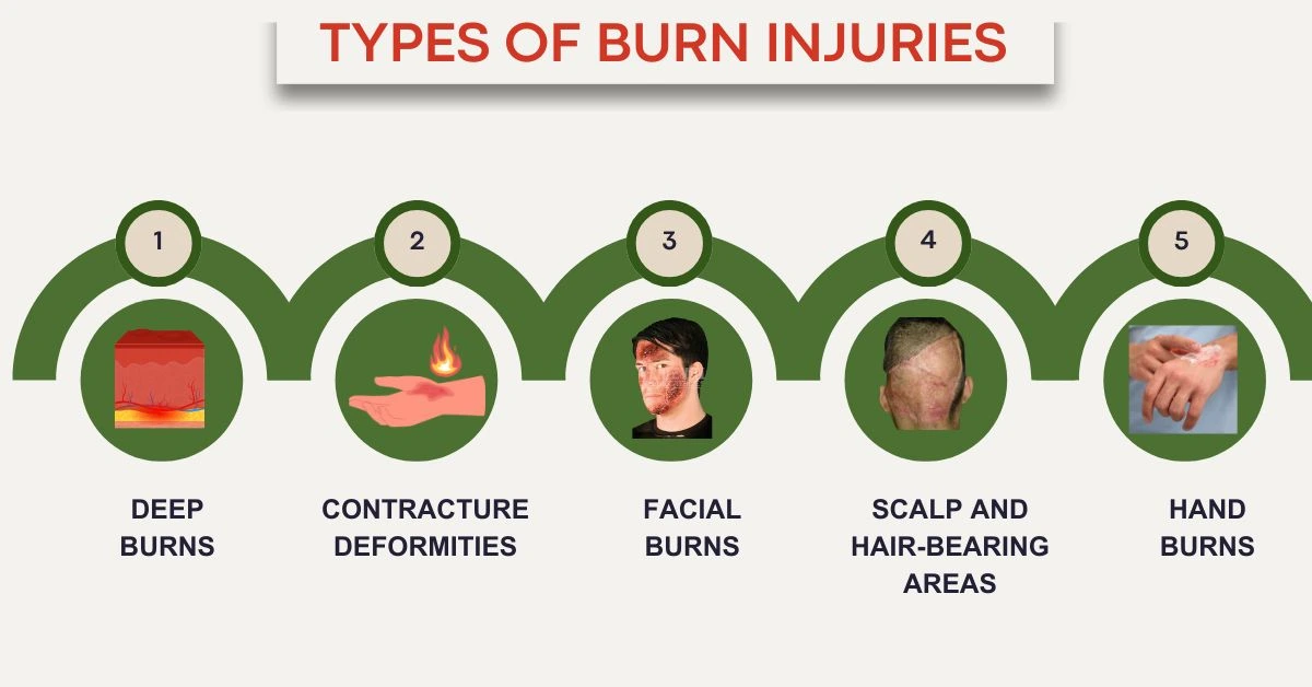 Types of Burn Injuries