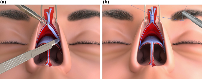 Why Primary Rhinoplasty Sometimes Falls Short